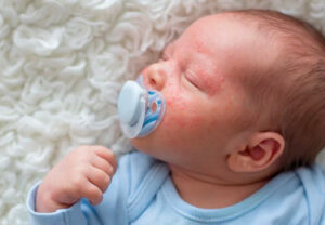 Leia mais sobre o artigo Acne Neonatal: O que Deve Saber